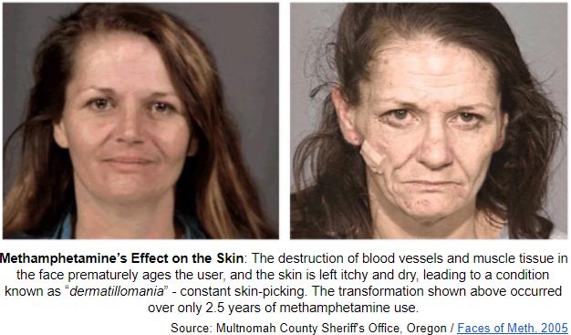 Meth effects on the face pictures