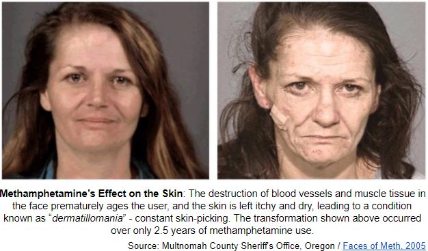 Before and After Meth Pictures - The Scary Truth About Meth Addiction
