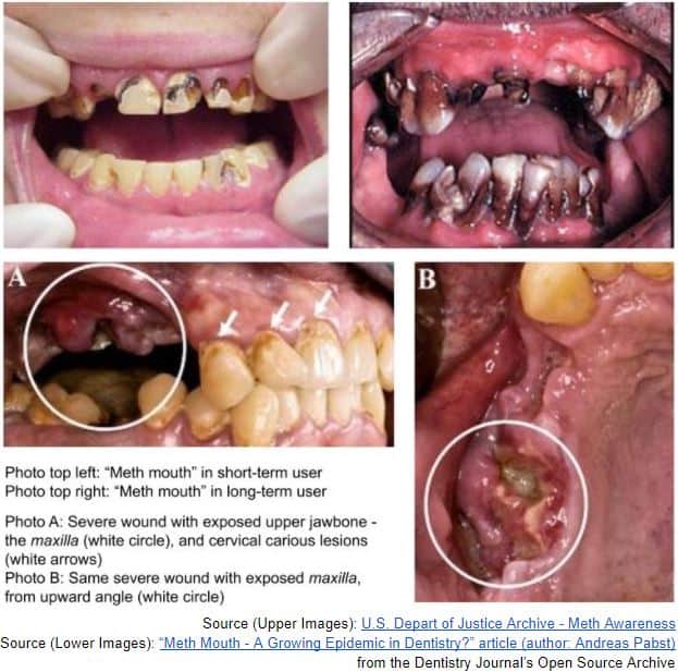 Meth mouth pictures