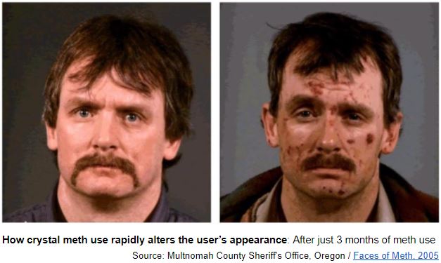 meth face before and after picture